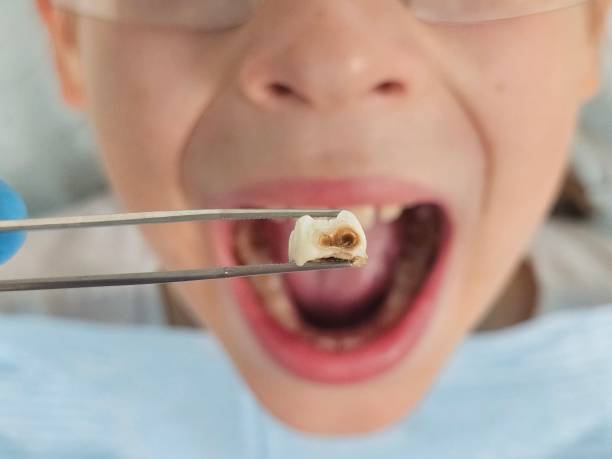 Best Emergency Dental Care for Sports Injuries in Dry Ridge, KY